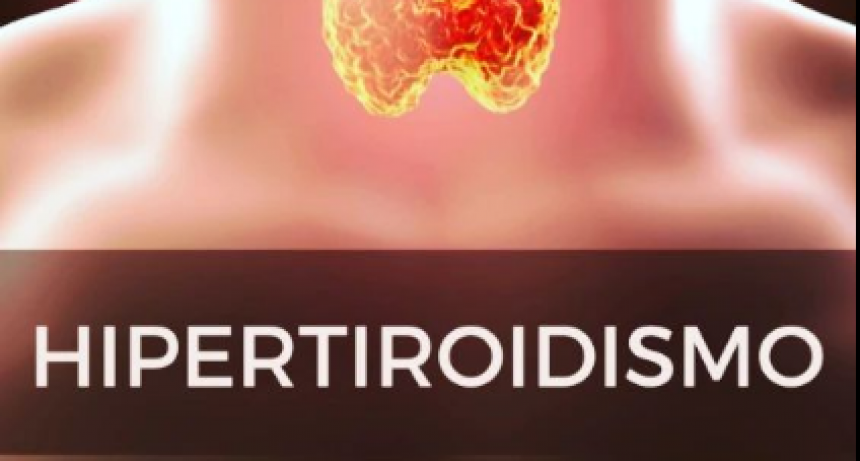 HIPERTIROIDISMO