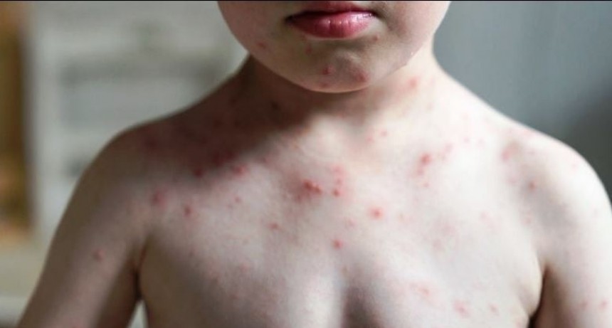 Alerta en la región por caso confirmado de Sarampión en Paraguay