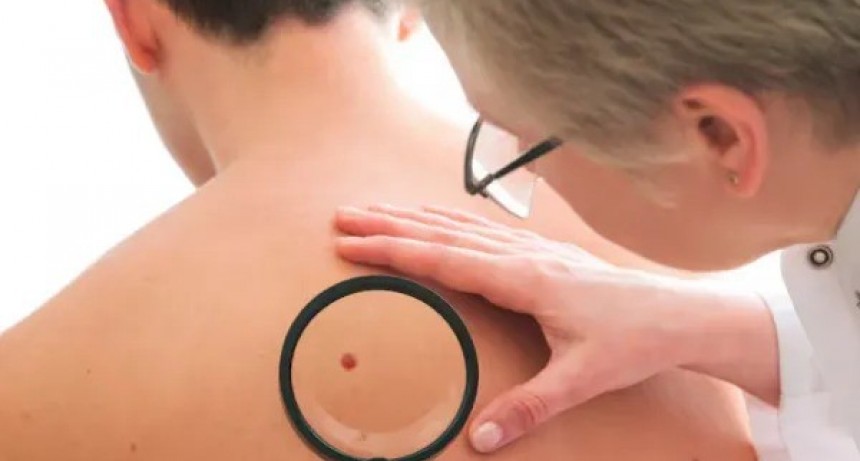 13 de junio: Día Mundial del Cáncer de Piel