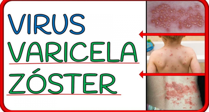 En el Colegio Industrial fueron reportados casos de varicela zoster