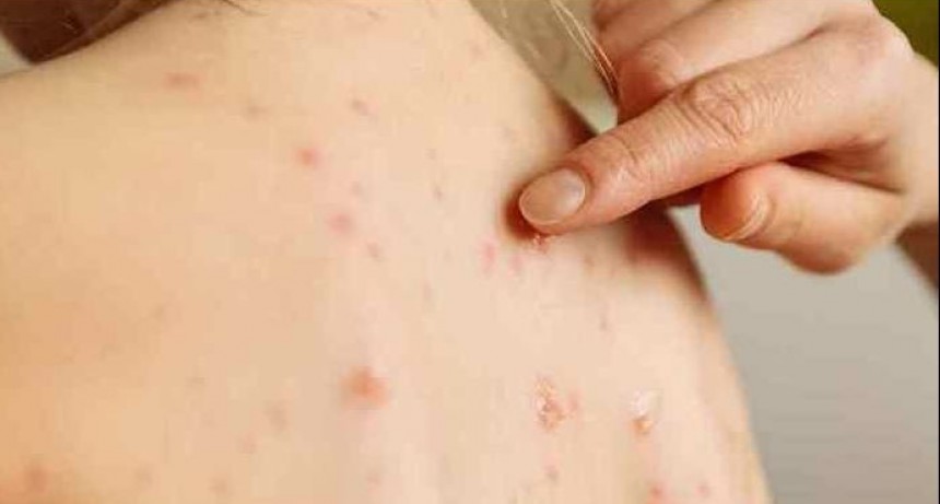 Varicela zóster: “En la época primaveral es cuando se tiene la mayor cantidad de casos”